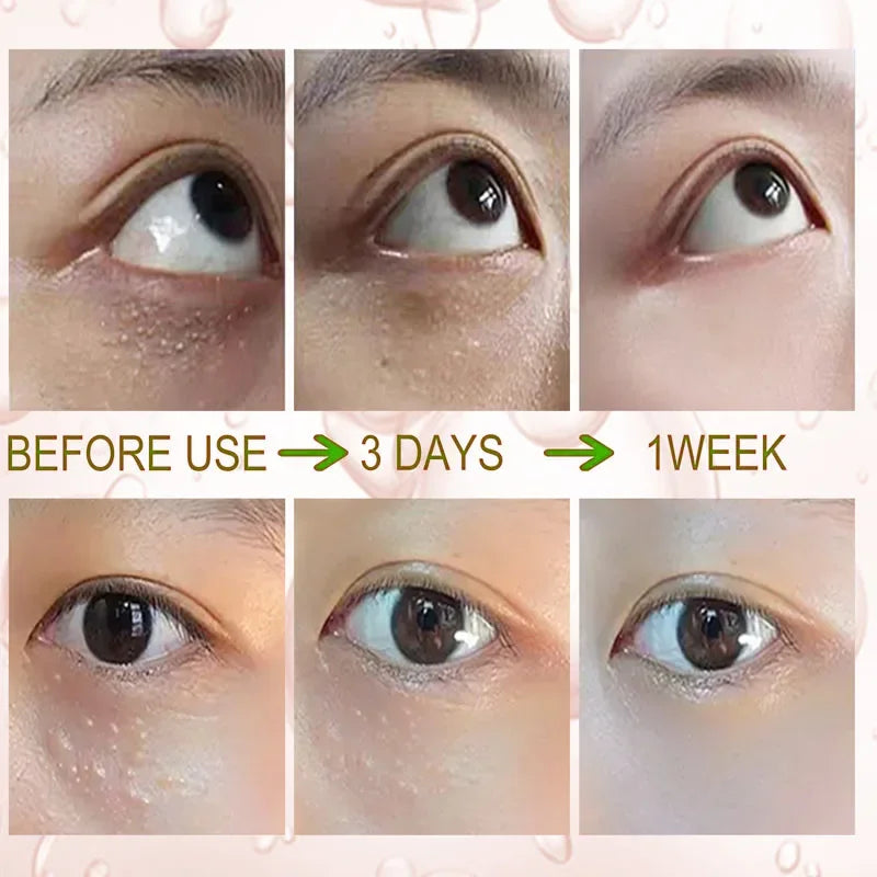 Anti Dark Circle Eye Cream Fat Granules Removal Cream Anti-Wrinkle Lifting Moisturizing Firming Anti-Puffiness Korean Skin Care